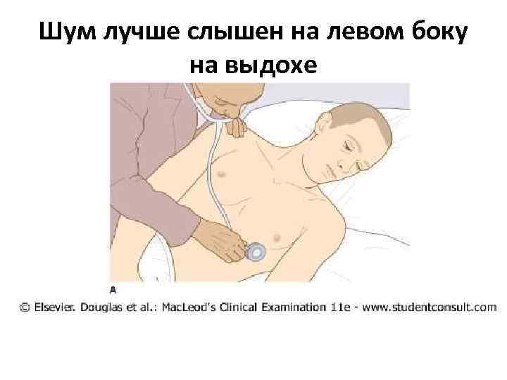 Шум лучше слышен на левом боку на выдохе 