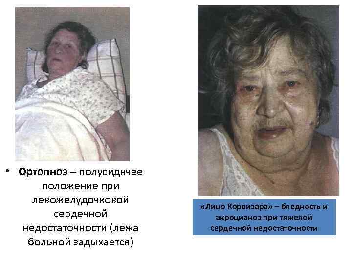 • Ортопноэ – полусидячее положение при левожелудочковой сердечной недостаточности (лежа больной задыхается) «Лицо • Ортопноэ – полусидячее положение при левожелудочковой сердечной недостаточности (лежа больной задыхается) «Лицо