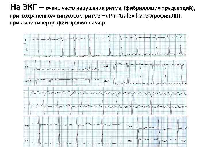 На ЭКГ – очень часто нарушения ритма (фибрилляция предсердий), при сохраненном синусовом ритме На ЭКГ – очень часто нарушения ритма (фибрилляция предсердий), при сохраненном синусовом ритме