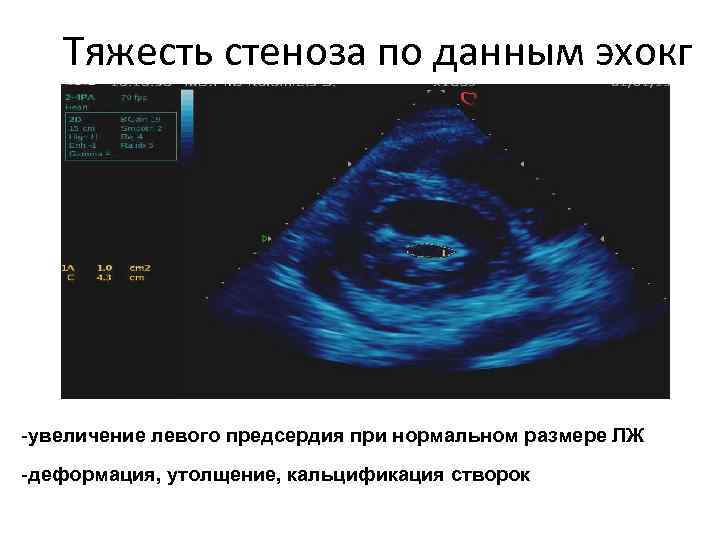 Тяжесть стеноза по данным эхокг -увеличение левого предсердия при нормальном размере ЛЖ -деформация, утолщение, Тяжесть стеноза по данным эхокг -увеличение левого предсердия при нормальном размере ЛЖ -деформация, утолщение,