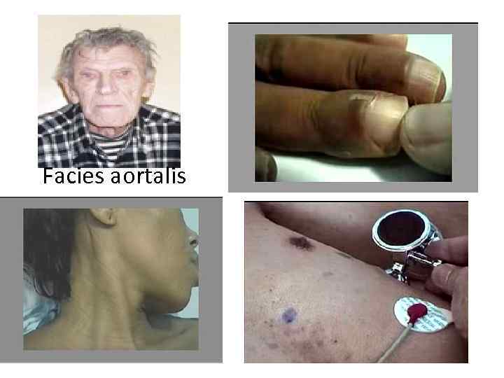 Facies aortalis Facies aortalis