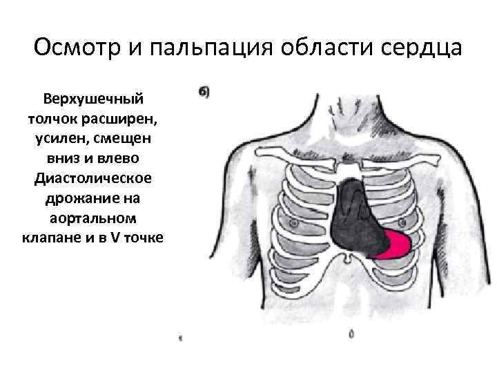 Осмотр и пальпация области сердца Верхушечный толчок расширен, усилен, смещен вниз и влево Диастолическое