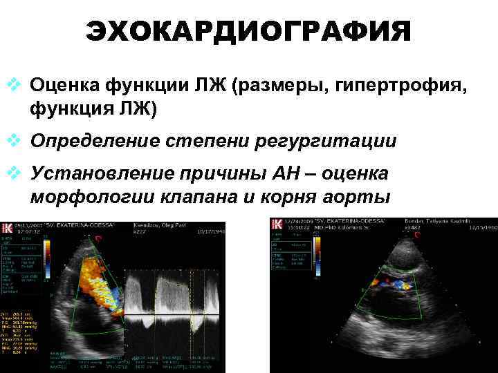 ЭХОКАРДИОГРАФИЯ v Оценка функции ЛЖ (размеры, гипертрофия, функция ЛЖ) v Определение степени регургитации v ЭХОКАРДИОГРАФИЯ v Оценка функции ЛЖ (размеры, гипертрофия, функция ЛЖ) v Определение степени регургитации v