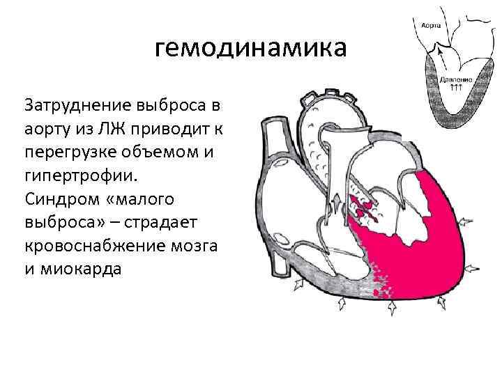 гемодинамика Затруднение выброса в аорту из ЛЖ приводит к перегрузке объемом и гипертрофии. Синдром