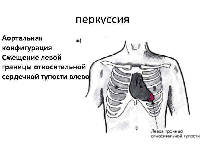 перкуссия Аортальная конфигурация Смещение левой границы относительной сердечной тупости влево перкуссия Аортальная конфигурация Смещение левой границы относительной сердечной тупости влево