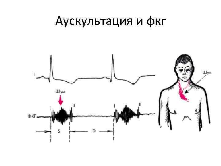 Аускультация и фкг Аускультация и фкг