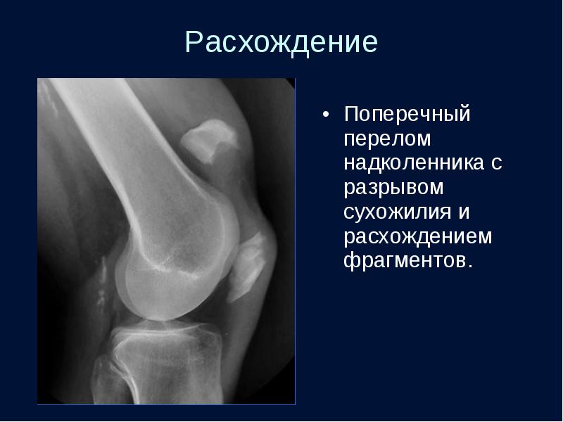 Код мкб закрытый перелом надколенника