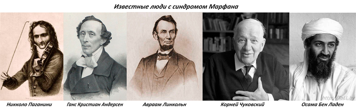 Известные люди с синдромом Марфана