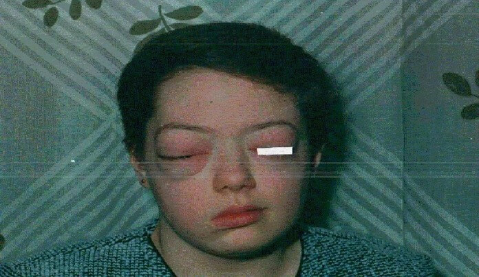 Болезнь Гиппеля - Линдау