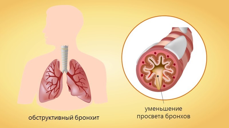 Обструктивный бронхит у взрослых