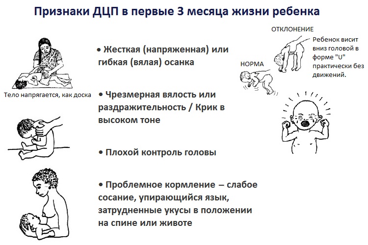Признаки ДЦП у новорожденного в первые 3 месяца