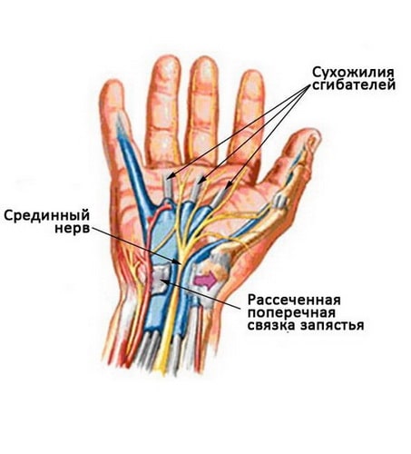 Цена операции при карпальном синдроме