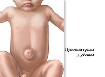 Пупочная грыжа