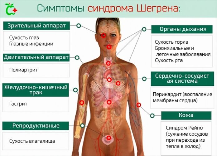 Синдром Шегрена