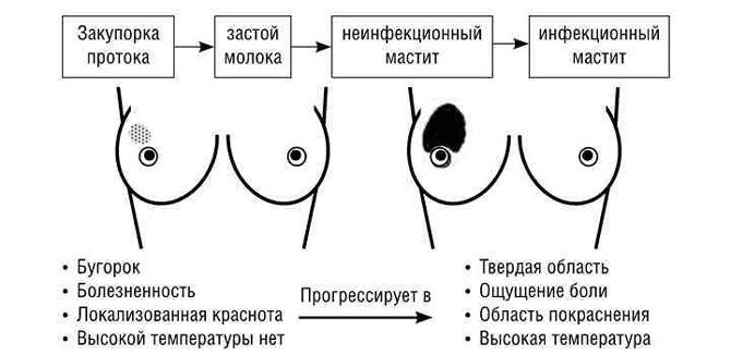 Мастит у кормящей матери код мкб