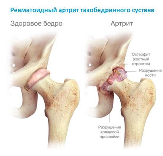 Воспалительные процессы суставов и мышц сопровождающиеся болевым синдромом