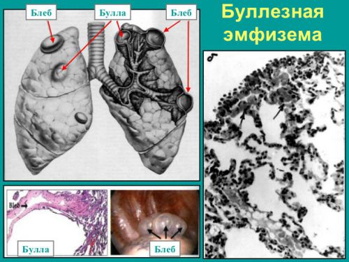 Буллезная эмфизема