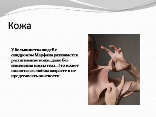 Кожа при синдроме Марфана