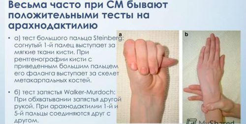Арахнодактилия