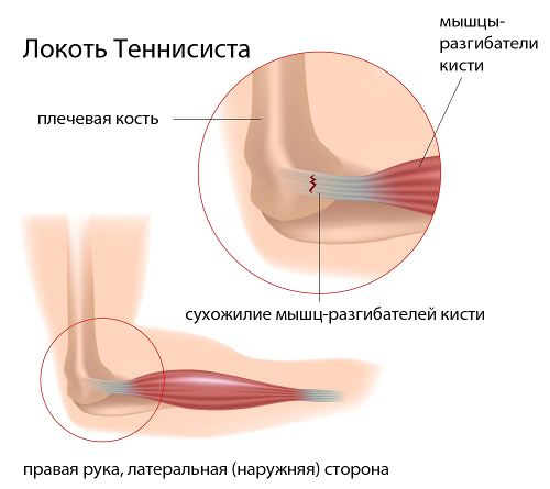 Эпикондилит
