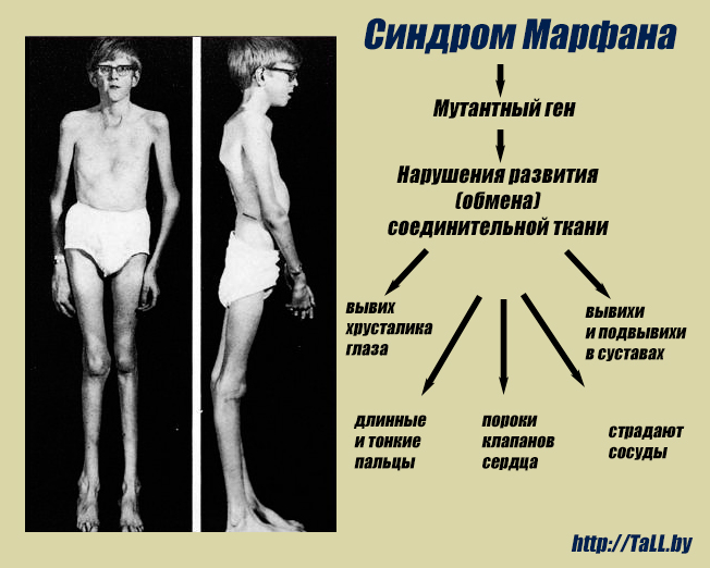 Синдром Марфана