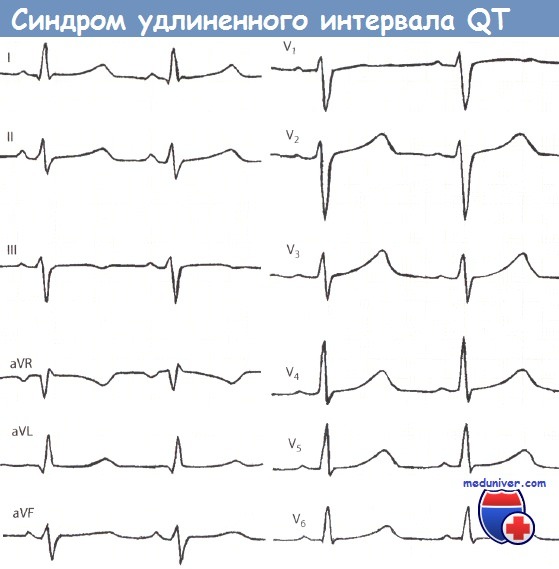 Синдром удлиненного интервала QT