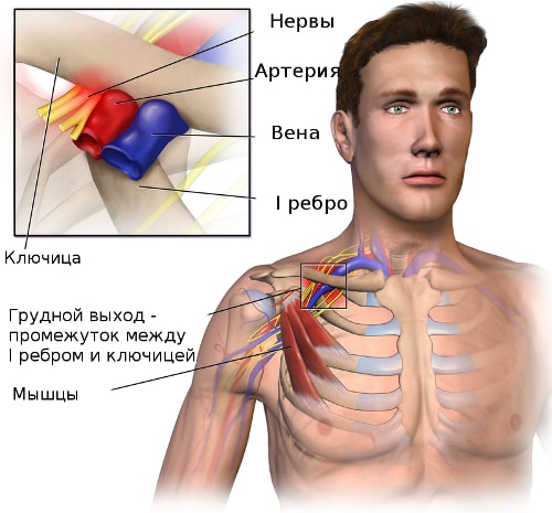 Схема формирования синдрома грудного выхода