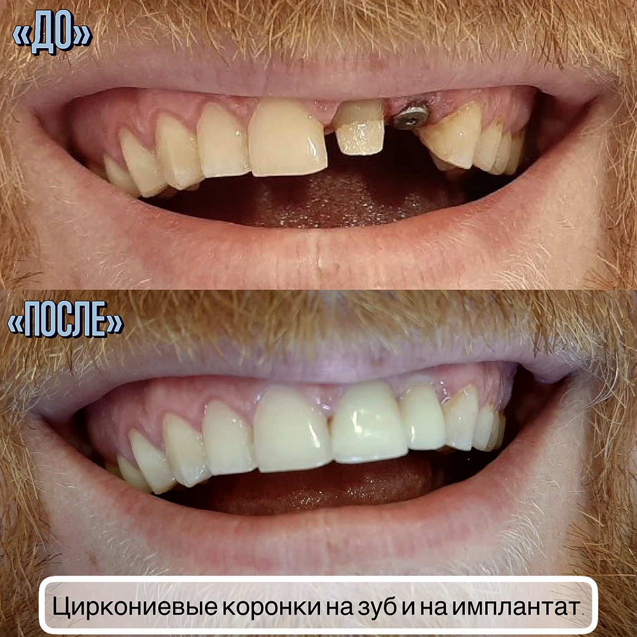 Циркониевые коронки на зуб и на имплантат.